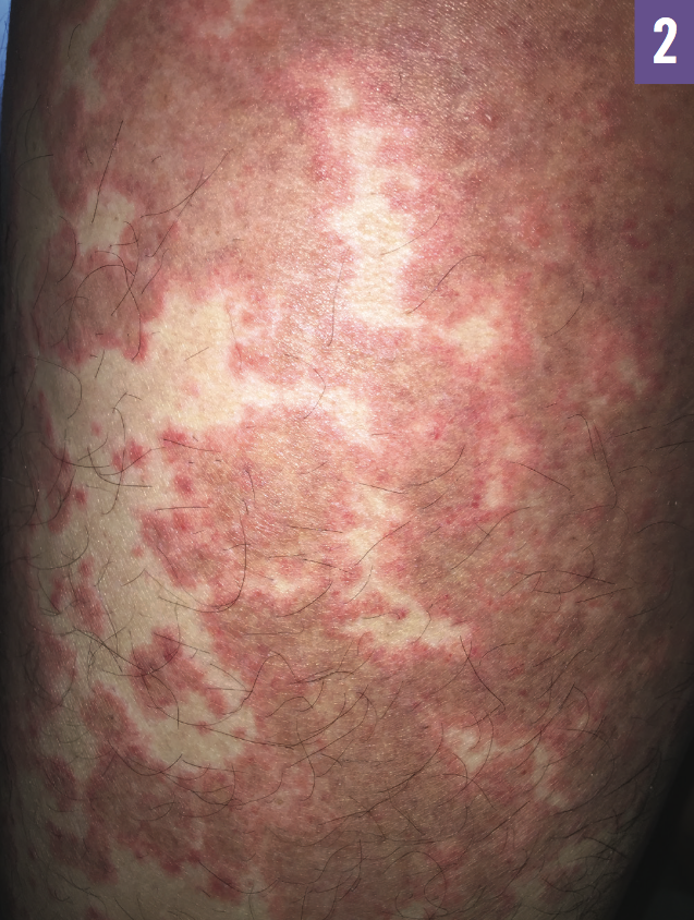 Prednisone For Hives Treatment